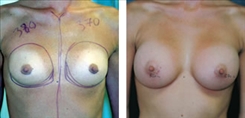 Breast Procedures Patient Before & After Photo 1