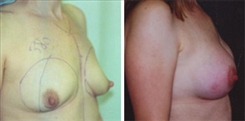 Breast Augmentation Patient Before & After Photo 1
