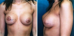 Breast Procedures Patient Before & After Photo 1