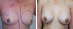 Breast Procedures Patient Before & After Photo 1