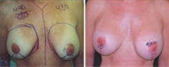 Breast Procedures Patient Before & After Photo 1