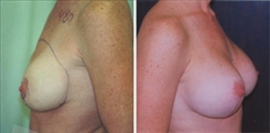 Breast Procedures Patient Before & After Photo 1
