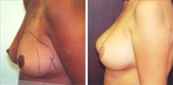 Breast Procedures Patient Before & After Photo 1