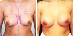 Breast Procedures Patient Before & After Photo 1