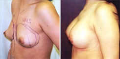 Breast Procedures Patient Before & After Photo 1