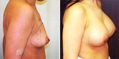 Breast Procedures Patient Before & After Photo 1