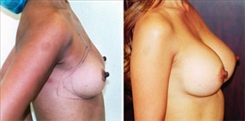 Breast Procedures Patient Before & After Photo 1