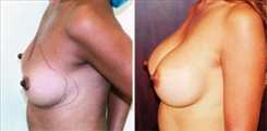 Breast Procedures Patient Before & After Photo 1