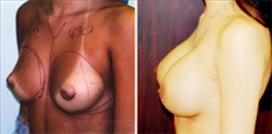 Breast Procedures Patient Before & After Photo 1