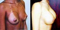 Breast Procedures Patient Before & After Photo 1