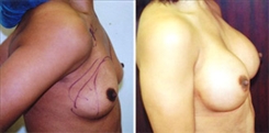 Breast Procedures Patient Before & After Photo 1