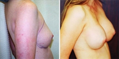 Breast Procedures Patient Before & After Photo 1