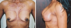 Breast Augmentation Patient Before & After Photo 1