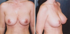 Breast Augmentation Patient Before & After Photo 1