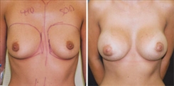 Breast Augmentation Patient Before & After Photo 1