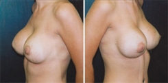 Breast Augmentation Patient Before & After Photo 1