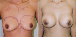 Breast Augmentation Patient Before & After Photo 1