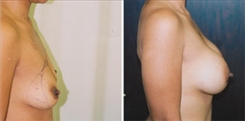 Breast Augmentation Patient Before & After Photo 1