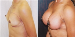 Breast Augmentation Patient Before & After Photo 1