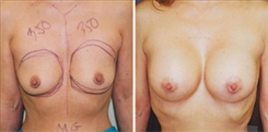 Breast Augmentation Patient Before & After Photo 1