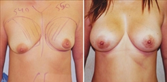 Breast Augmentation Patient Before & After Photo 1