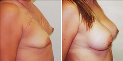 Breast Augmentation Patient Before & After Photo 1