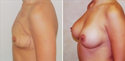 Breast Augmentation Patient Before & After Photo 1