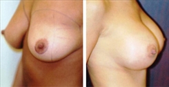 Breast Augmentation Patient Before & After Photo 1