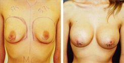 Breast Augmentation Patient Before & After Photo 1