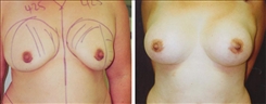 Breast Augmentation Patient Before & After Photo 1