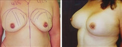 Breast Augmentation Patient Before & After Photo 1