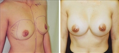 Breast Augmentation Patient Before & After Photo 1