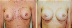 Breast Augmentation Patient Before & After Photo 1