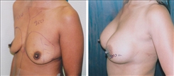 Breast Augmentation Patient Before & After Photo 1