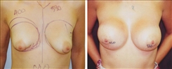 Breast Augmentation Patient Before & After Photo 1