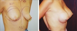 Breast Augmentation Patient Before & After Photo 1