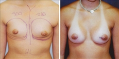 Breast Augmentation Patient Before & After Photo 1