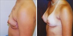 Breast Augmentation Patient Before & After Photo 1