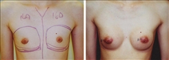 Breast Augmentation Patient Before & After Photo 1