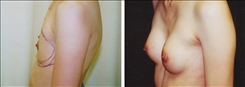 Breast Augmentation Patient Before & After Photo 1