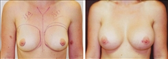 Breast Augmentation Patient Before & After Photo 1