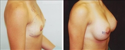 Breast Augmentation Patient Before & After Photo 1