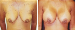 Breast Augmentation Patient Before & After Photo 1