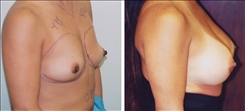 Breast Augmentation Patient Before & After Photo 1