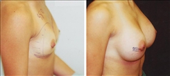 Breast Augmentation Patient Before & After Photo 1