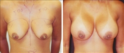 Breast Augmentation Patient Before & After Photo 1