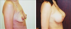 Breast Augmentation Patient Before & After Photo 1