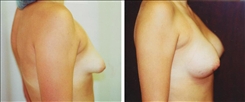 Breast Augmentation Patient Before & After Photo 1