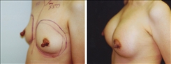 Breast Augmentation Patient Before & After Photo 1