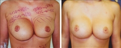 Breast Augmentation Patient Before & After Photo 1